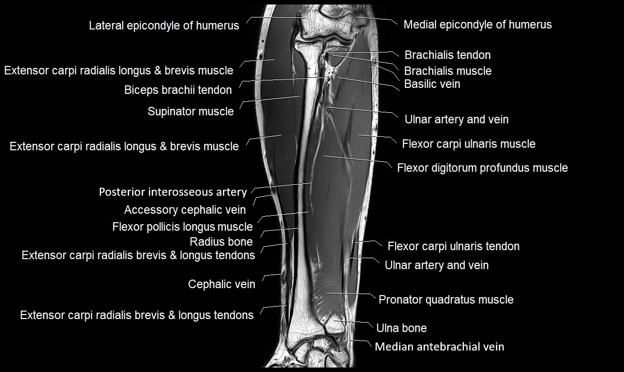 MRI 3T forearm coronal cross sectional anatomy image 14.webp